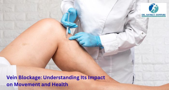 Vein Blockage: Understanding Its Impact on Movement and Health