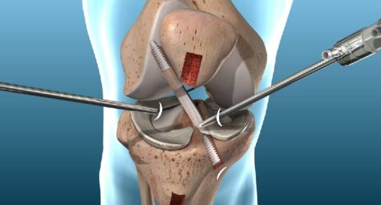 ACL-and-PCL-Reconstruction1-768x512