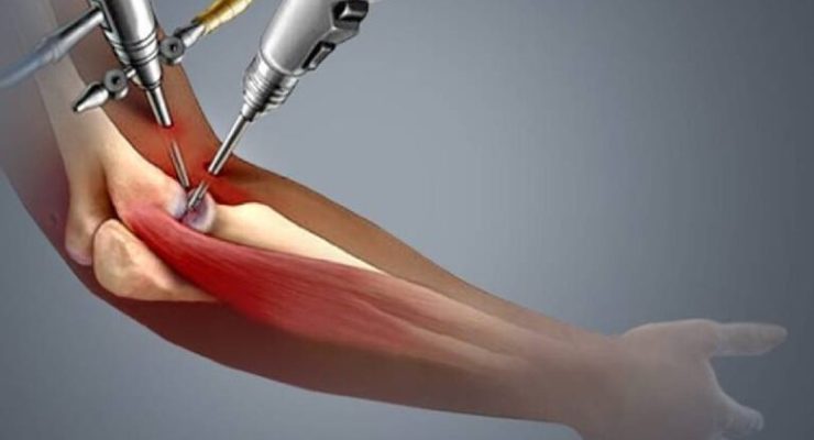 Elbow-Replacement-Surgery1-768x512