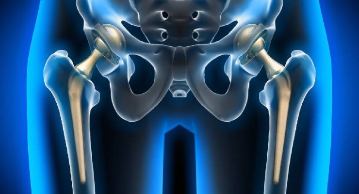 Hip-Replacement1