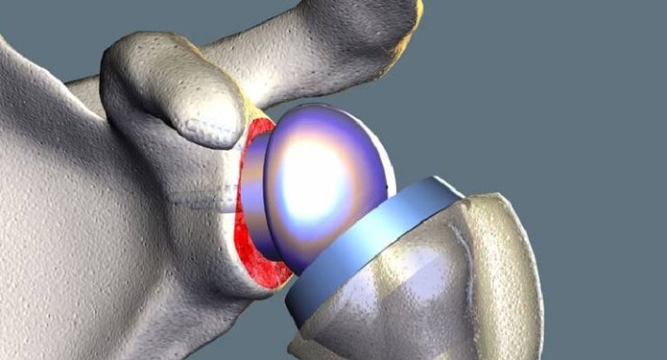 Shoulder-Replacement-Surgery-768x512